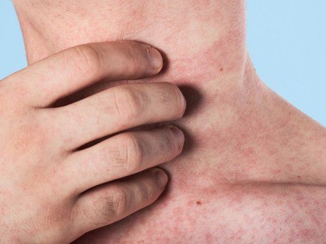 Gia tăng ca mắc sởi: Bác sĩ chỉ cách nhận biết và phòng ngừa các biến chứng