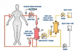 Hiểu đúng về công nghệ lọc huyết tương bằng hai quả lọc