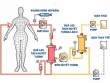 Hiểu đúng về công nghệ lọc huyết tương bằng hai quả lọc