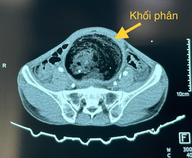 Khối phân kích thước lớn trong đại trực tràng bệnh nhân. Ảnh: BVCC.