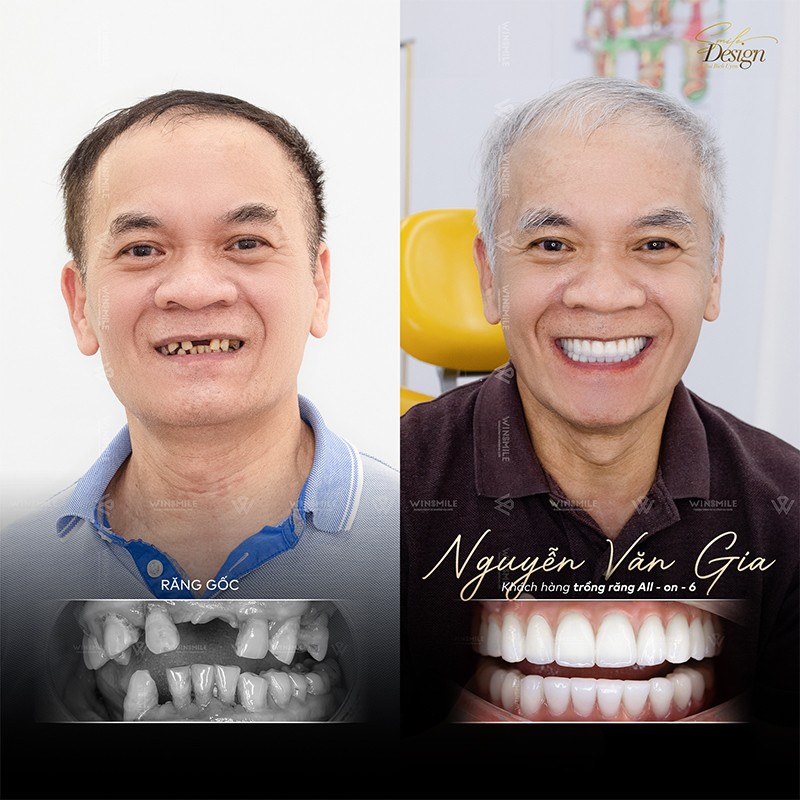 Trồng răng cá nhân hóa - Xu hướng nha khoa hiện đại - 5