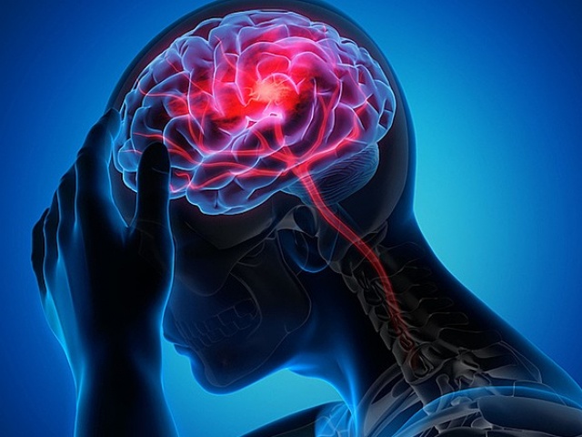 5 yếu tố nguy cơ gây đột quỵ ở người trẻ