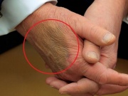 Thế giới - Vết bầm tím lớn trên tay ông Trump gây xôn xao, Nhà Trắng lên tiếng