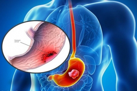 4 thực phẩm giúp phòng ngừa viêm loét dạ dày hiệu quả, người Việt nên...