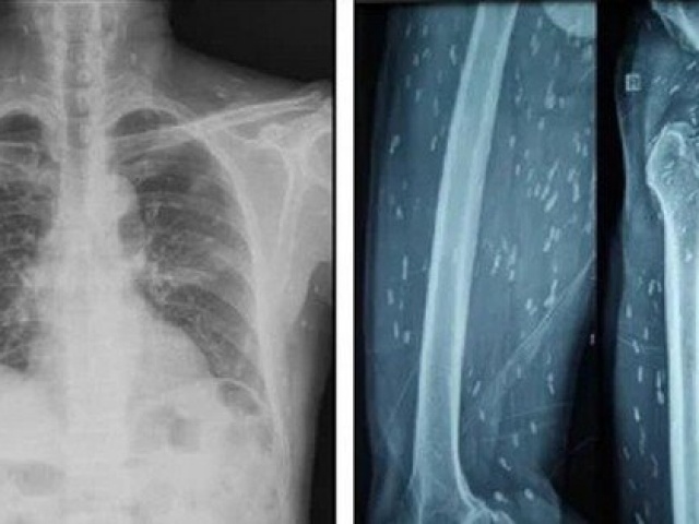 Sán làm tổ chi chít khắp cơ thể vì món khoái khẩu nhiều người Việt “nghiện“