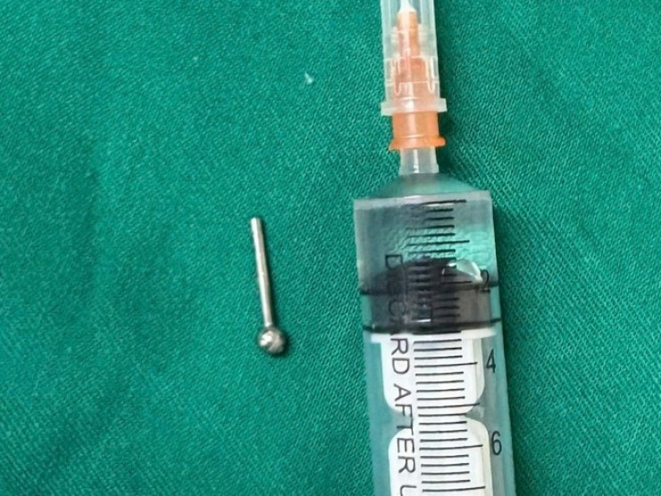 Hy hữu: Cô gái 19 tuổi suýt thủng dạ dày vì nuốt phải khuyên đeo ở lưỡi