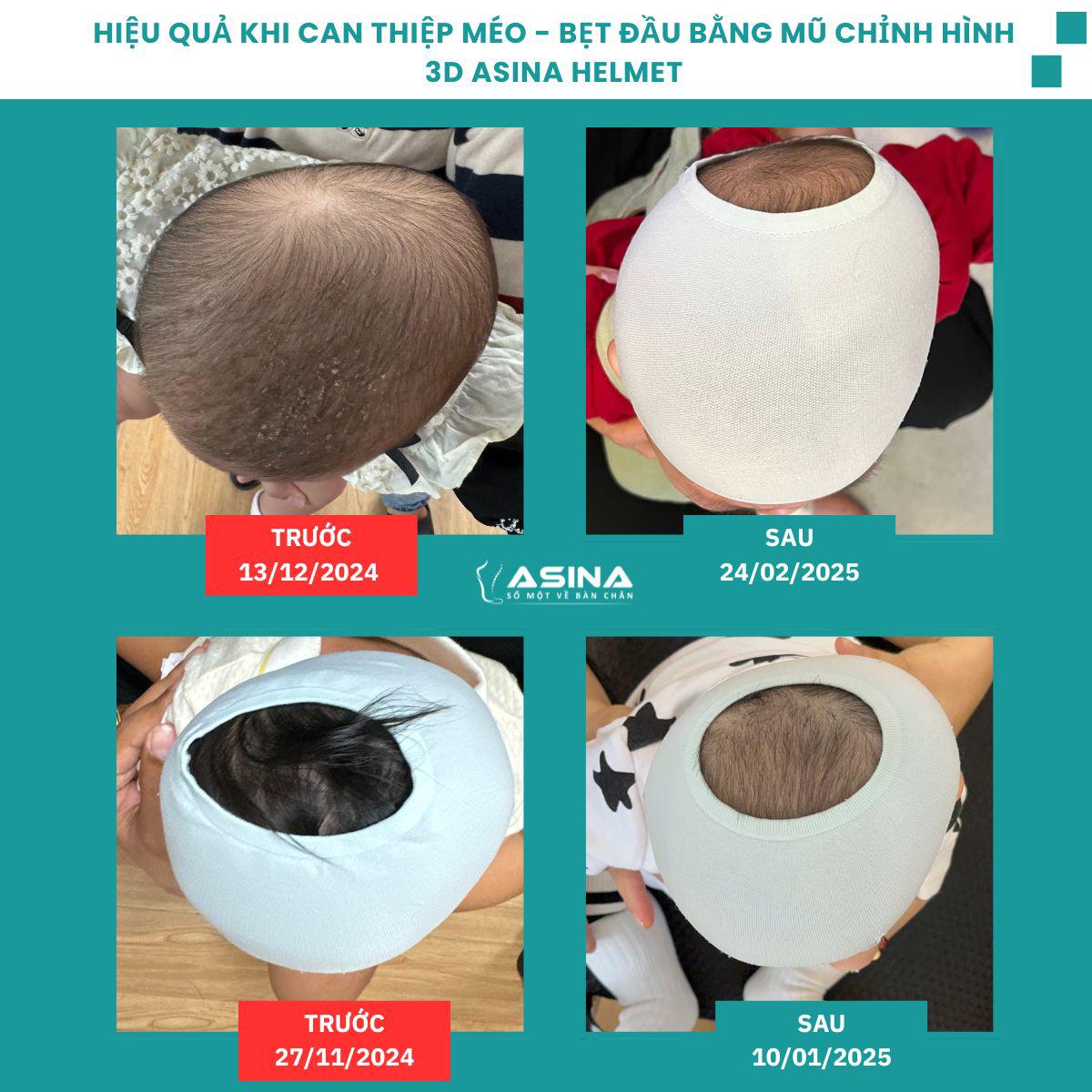 Cải thiện rõ rệt của các bé đã minh chứng cho hiệu quả của mũ chỉnh hình 3D ASINA