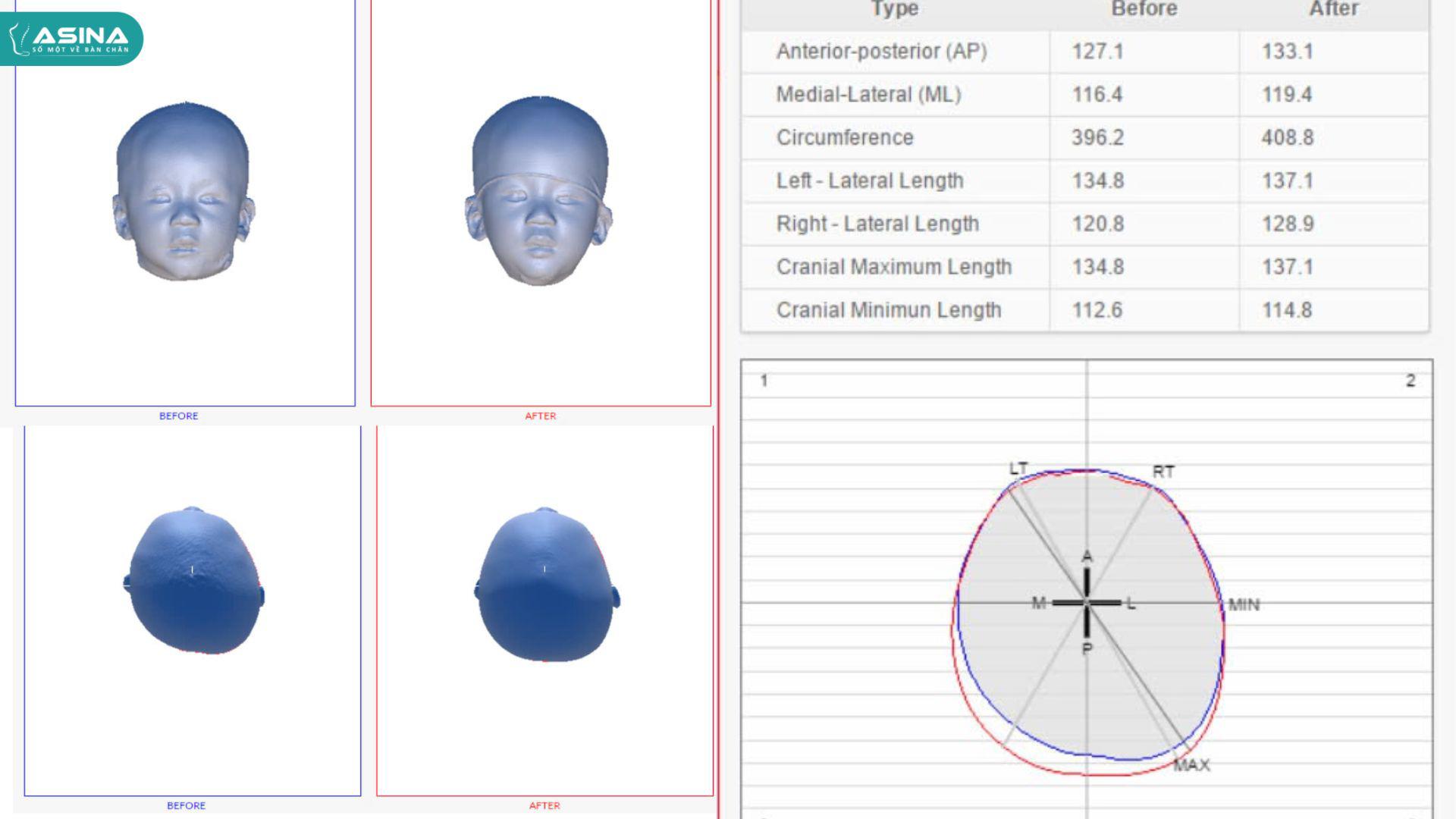Hình ảnh tái tạo hình dạng đầu trẻ bằng công nghệ quét 3D