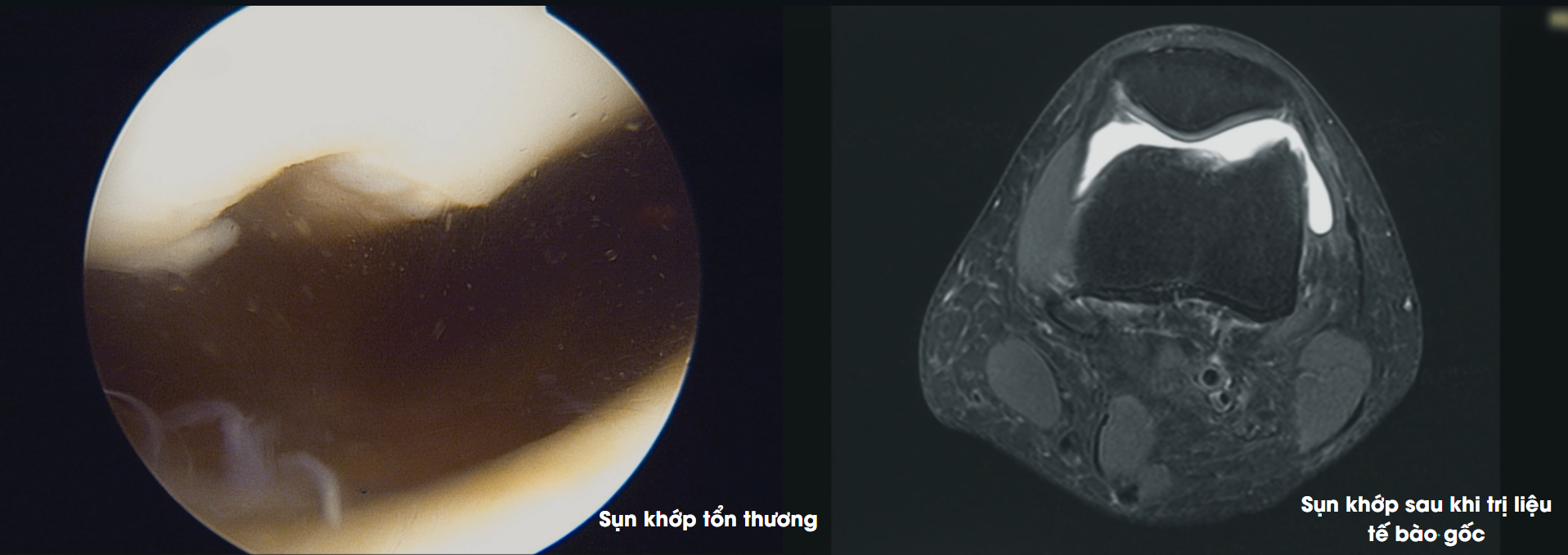 Hình ảnh so sánh sụn khớp của Yuki Sato trước và sau khi trị liệu tế bào gốc - Nguồn: Discovery Channel