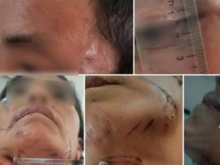 Bị đánh đập, treo lên cây do bị nghi làm bùa ngải khiến người khác tử vong