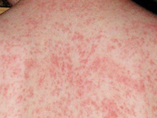 Hà Nội: Hơn 100 trường hợp mắc sởi trong tuần, khuyến cáo cách bảo vệ con trong những ngày thời tiết nồm ẩm