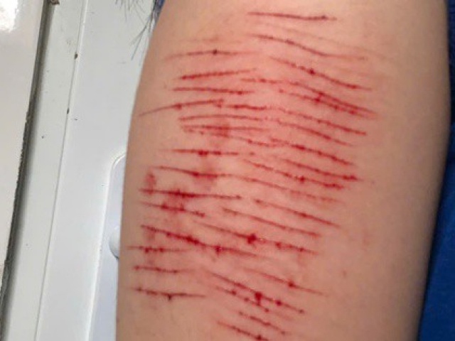 Thiếu nữ 15 tuổi tự rạch tay gây thương tích phải nhập viện, đâu là lý do?