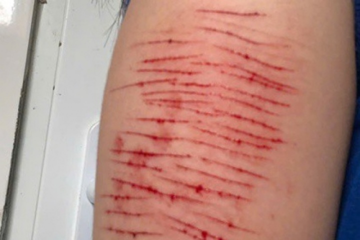 Thiếu nữ 15 tuổi tự rạch tay gây thương tích phải nhập viện, đâu là lý do?