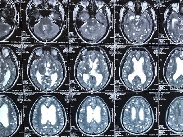 Rối loạn tâm thần do sán làm tổ trong não