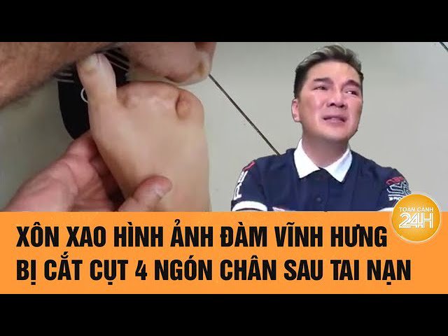 Trước đó mạng xã hội xôn xao chuyện ca sĩ Đàm Vĩnh Hưng mất đến 4 ngón chân sau tai nạn