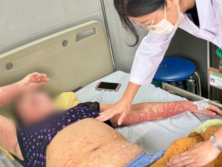 Người phụ nữ có men gan tăng gấp 8 lần, mặt biến dạng vì lý do này