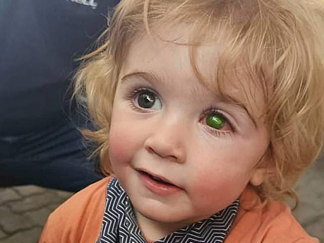 Bé trai mù một mắt vì nụ hôn của người thân