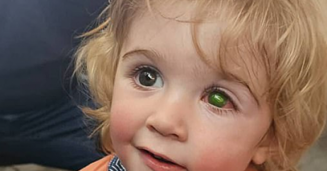 Bé trai mù một mắt vì nụ hôn của người thân