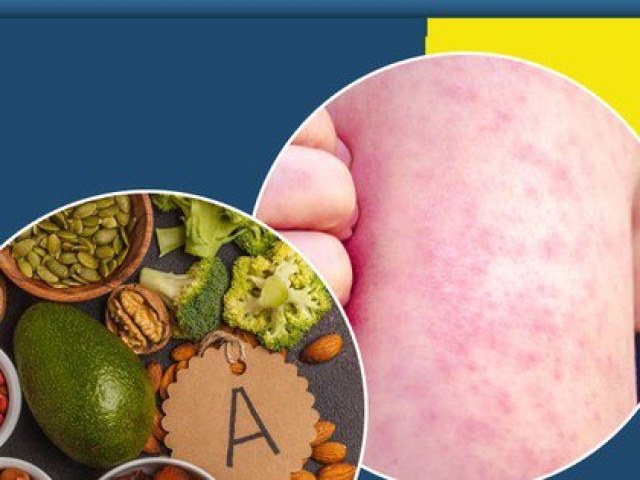 Trẻ bị sởi nên ăn gì, kiêng gì?