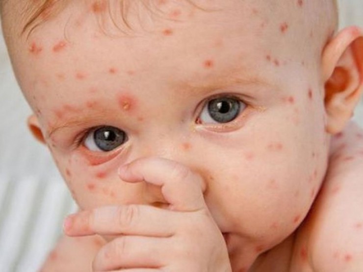 90% người chưa có miễn dịch dễ mắc căn bệnh này