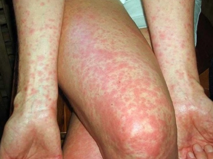 Dịch sởi đang diễn biến phức tạp, Bộ Y tế ra khuyến cáo mới nhất