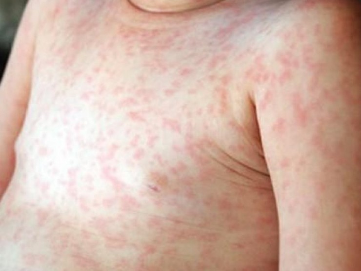 Những điều phải biết khi điều trị bệnh sởi để tránh biến chứng nguy hiểm