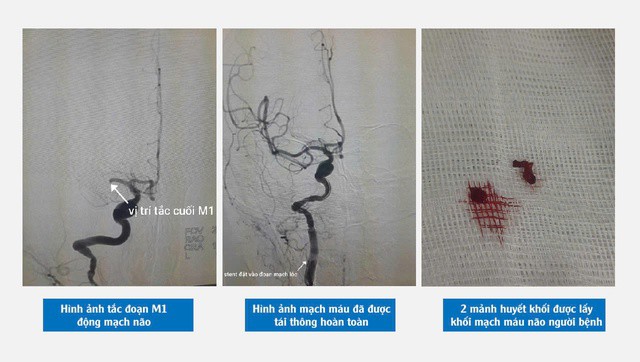 Hình ảnh cho thấy người bệnh bị nhồi máu não và huyết khối được lấy ra từ mạch máu não người bệnh. Ảnh: BVCC.