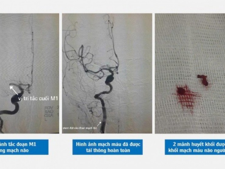 Đang đun bếp lúc sáng sớm, người phụ nữ 49 tuổi bất ngờ bị đột quỵ