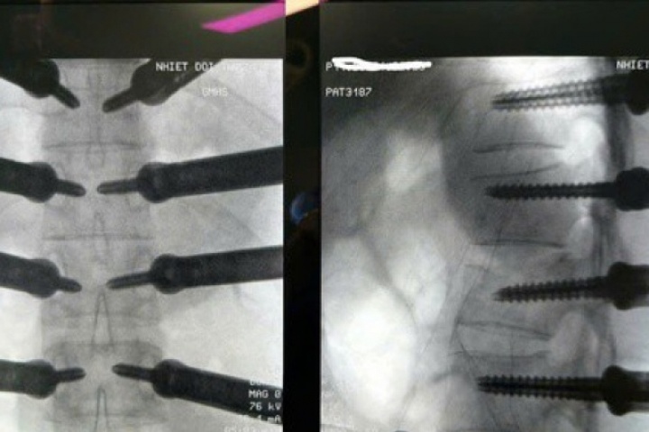 Cứu cột sống cho thanh niên ngã từ độ cao 4 m