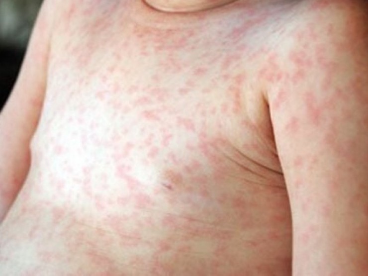 Bệnh sởi đang diễn biến phức tạp, 7 điều cha mẹ nhất định phải biết để bảo vệ trẻ