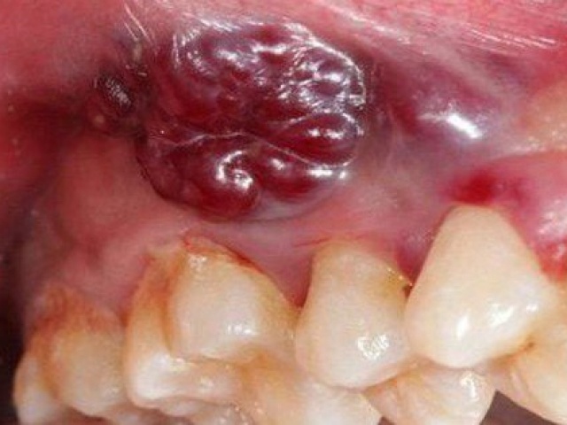 8 dấu hiệu cảnh báo ung thư khoang miệng