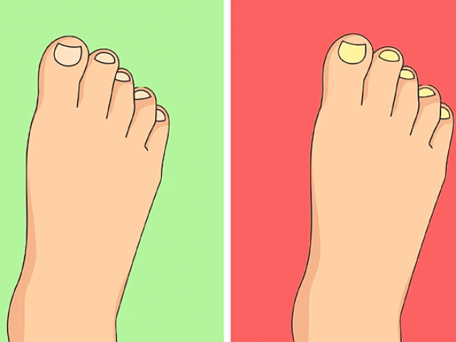 5 dấu hiệu ở móng chân “tố cáo“ bệnh tật tiềm ẩn