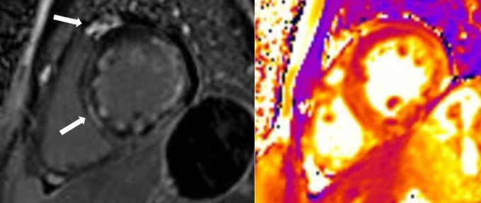 Hình cộng hưởng từ bệnh nhân ghi nhận nhiều tín hiệu viêm cơ tim (mũi tên màu trắng). Ảnh: BVCC