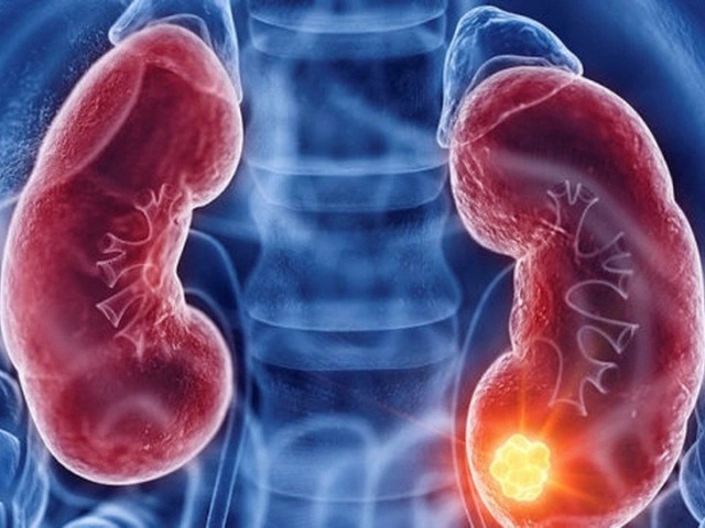 Ung thư thận dễ bị bỏ sót, chỉ phát hiện khi trong nước tiểu có máu