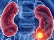 Ung thư thận dễ bị bỏ sót, chỉ phát hiện khi trong nước tiểu có máu