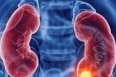 Ung thư thận dễ bị bỏ sót, chỉ phát hiện khi trong nước tiểu có máu