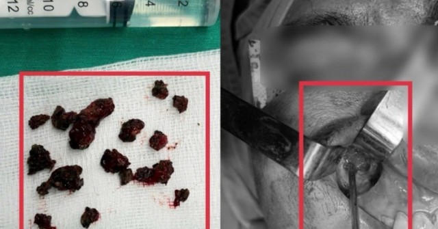 Nấm đen ăn mòn xương xoang hàm người đàn ông khỏe mạnh