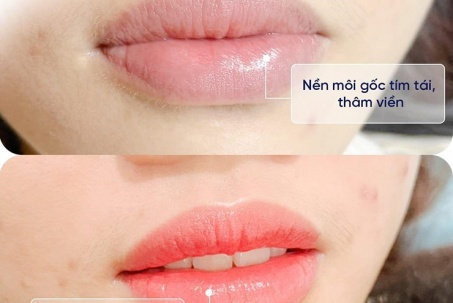 Thẩm mỹ viện Seoul Center - Điểm đến phun môi đẹp, an toàn, bền màu