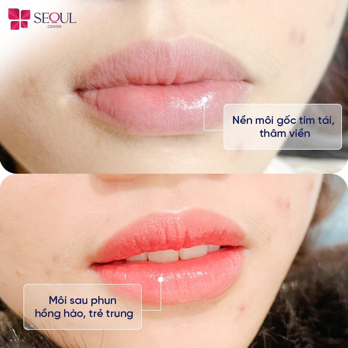 Phun môi tại Seoul Center khách hàng sẽ nhanh chóng sở hữu đôi môi hồng hào, tươi tắn, mềm mọng ưng ý