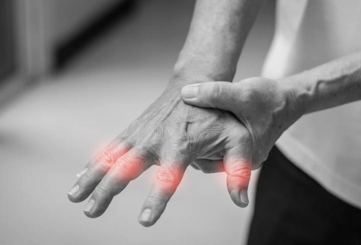 Viêm khớp dạng thấp là bệnh tự miễn dịch, xảy ra khi hệ miễn dịch tấn công nhầm lớp lót của khớp, gây viêm, sưng đau và cứng khớp kéo dài. Ảnh: Unsplash