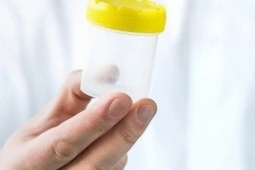 Tinh dịch đổi màu: Dấu hiệu bệnh lý không thể chủ quan