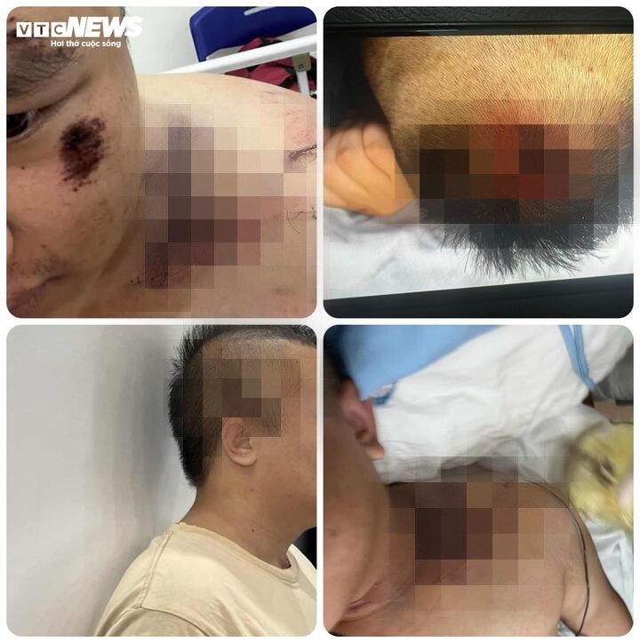 Những thương tích in hằn trên cơ thể Nguyễn Đức H. sau khi trải qua "khóa đào tạo" tại Trung tâm Hải Hà. (Ảnh: Gia đình cung cấp)