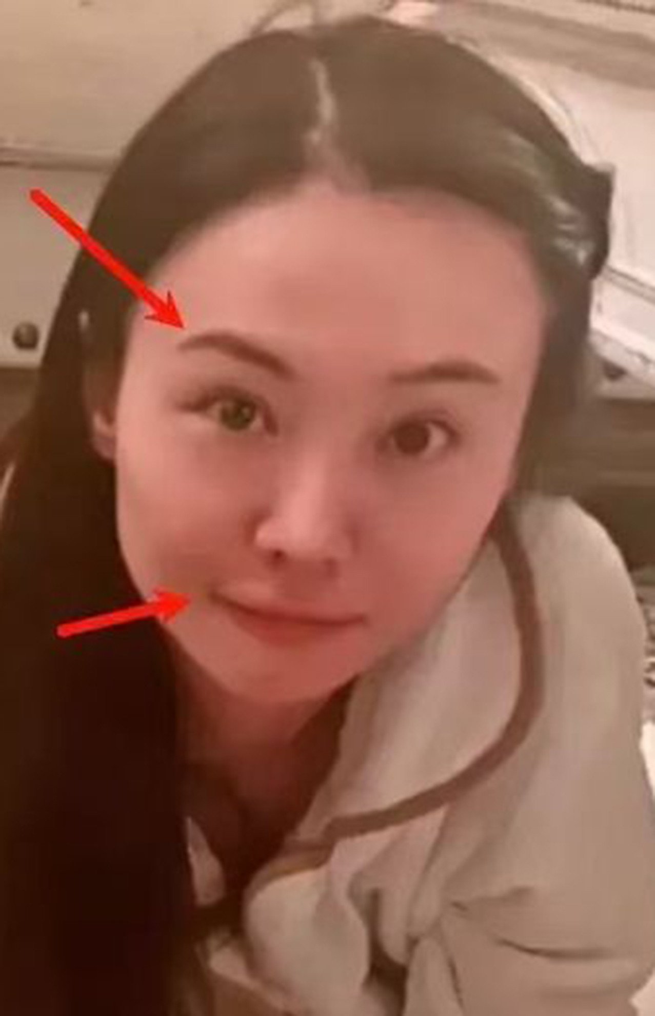 Diễn viên Trịnh Sảng lộ gương mặt khác lạ với phần má căng phồng, môi sưng và bị lệch.&nbsp;