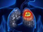 Vì sao ung thư phổi có tỷ lệ tử vong cao?