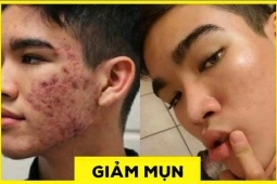 Tin tức sức khỏe - Đàn ông con trai bị mụn: Chấm dung dịch này mỗi tối là sạch sẽ, không cần đi Spa với bôi kem như con gái