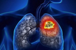Vì sao ung thư phổi có tỷ lệ tử vong cao?