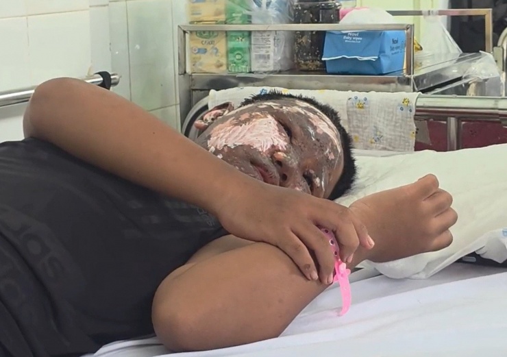 Khuôn mặt bệnh nhi bị cháy đen, bỏng nặng khi chơi pháo nổ bán trái phép trên mạng xã hội