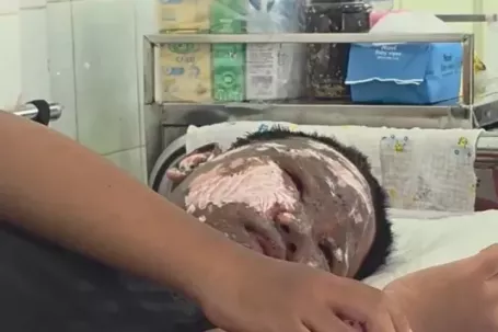 Chơi pháo nổ, bé trai bị tai nạn cháy đen khuôn mặt