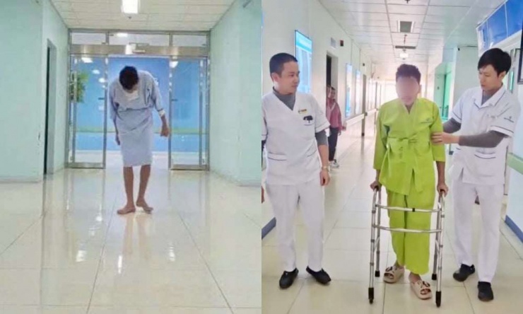 Nam bệnh nhân trước phẫu thuật, rất khó khăn trong di chuyển và sinh hoạt (ảnh trái) và sau ca phẫu thuật có thể nhìn thẳng về phía trước. Ảnh: BVCC.