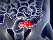 Mắc hai loại ung thư đường tiêu hóa